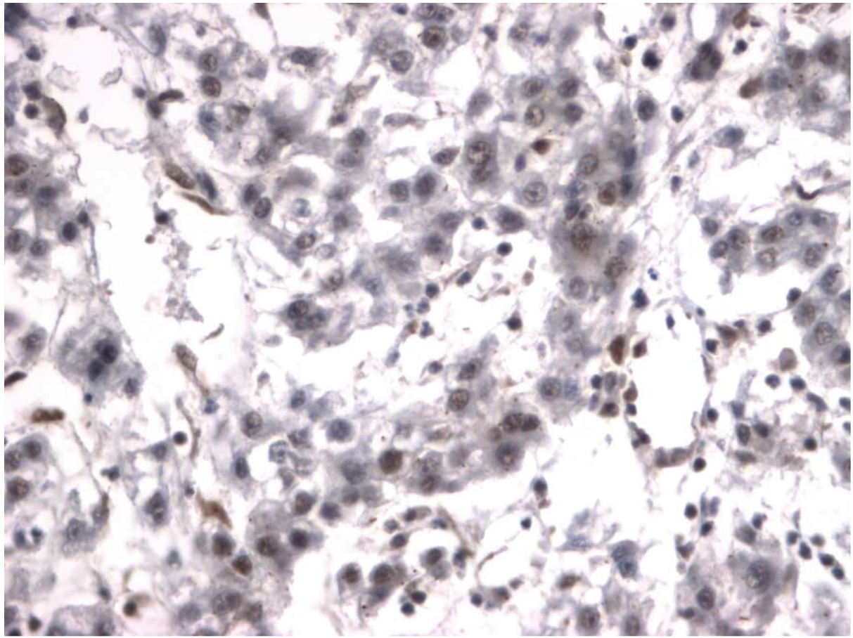 "Immunohistochemical staining of human hepatocellular carcinoma tissue using HSF1 antibody (Cat. No. X2791P).  Antibody used at 2 µg/ml. 40x magnification. 
Pathologists comments: Nuclear staining in some neoplastic cells."